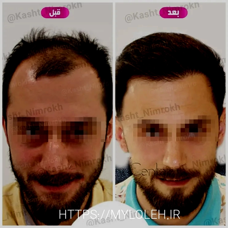 کاشت مو تهران