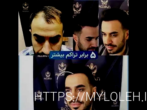 کاشت مو تهران